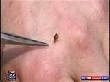Bed Bugs Russian