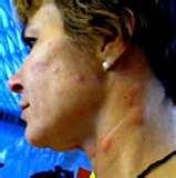 Bed Bugs Los Angeles Hotels