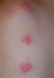 Bed Bugs Assistance
