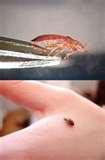 pictures of Bed Bugs Under Skin