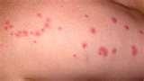 Pictures Of Bed Bugs Rashes