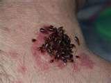 Pictures Of Bed Bugs Rashes images