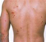 images of Pictures Of Bed Bugs Rashes