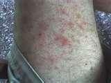 Bed Bugs Skin Rash Pictures