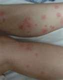 photos of Bed Bugs Skin Rash Pictures