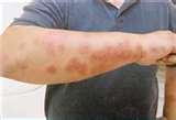 Bed Bugs Eat Dead Skin photos
