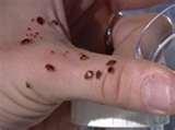 Bed Bugs Poison photos