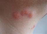 Bed Bugs Breakfast Lunch Dinner images Bed Bugs Breakfast Lunch Dinner images