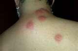 photos of Bed Bugs Breakfast Lunch Dinner photos of Bed Bugs Breakfast Lunch Dinner