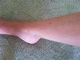 Bed Bugs Update photos Bed Bugs Update photos