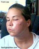 photos of Are Bed Bugs Deadly