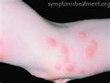Bed Bugs Breakfast Lunch Dinner pictures Bed Bugs Breakfast Lunch Dinner pictures