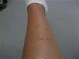 Bed Bugs Update Bed Bugs Update