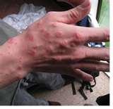 photos of Bed Bugs Ri photos of Bed Bugs Ri