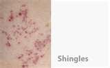 photos of Bed Bugs Scalp