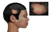 Bed Bugs Scalp pictures