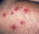 Bed Bugs Scalp pictures