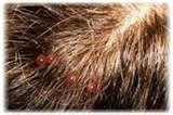 photos of Bed Bugs Scalp