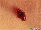 pictures of Bed Bugs 911 Review