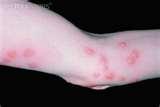 Bed Bugs Get Rid Of Them images Bed Bugs Get Rid Of Them images