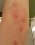 Bed Bugs Itch images