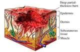 Bed Bugs 2nd Treatment Bed Bugs 2nd Treatment