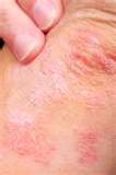 Bed Bugs Yeast Infection images Bed Bugs Yeast Infection images