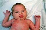 pictures of Bed Bugs Yeast Infection pictures of Bed Bugs Yeast Infection