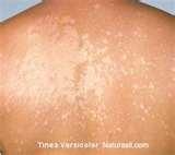 photos of Bed Bugs Yeast Infection photos of Bed Bugs Yeast Infection