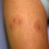 Bed Bugs Yeast Infection pictures Bed Bugs Yeast Infection pictures