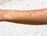 photos of Bed Bugs Delayed Reaction Bites photos of Bed Bugs Delayed Reaction Bites