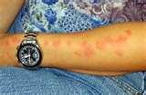 Bed Bugs Delayed Reaction Bites photos Bed Bugs Delayed Reaction Bites photos