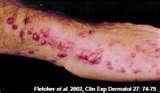 Bed Bugs Delayed Reaction Bites photos Bed Bugs Delayed Reaction Bites photos