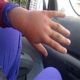 photos of Bed Bugs Queensland