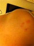 pictures of Photos Of Bed Bug Bites