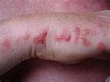 Bed Bugs Bites Pictures