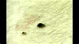 photos of Bed Bugs Denver