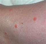 images of Photos Of Bed Bug Bites