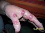 Bed Bugs Florida photos