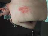 pictures of Bed Bugs Las Vegas