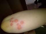 Photos Of Bed Bug Bites images