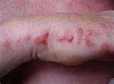 photos of Bed Bugs Bites Pictures