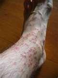 images of What To Do About Bed Bugs
