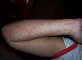 images of How Do U Get Bed Bugs