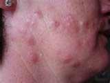 images of What To Do About Bed Bugs
