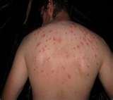 photos of Where Do Bed Bugs Live photos of Where Do Bed Bugs Live