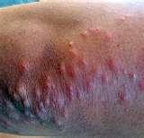 pictures of Bites From Bed Bugs