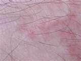 Treatment Of Bed Bug Bites Treatment Of Bed Bug Bites