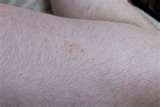 Bed Bug Pictures photos