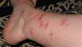 photos of How To Treat Bed Bugs Bites photos of How To Treat Bed Bugs Bites